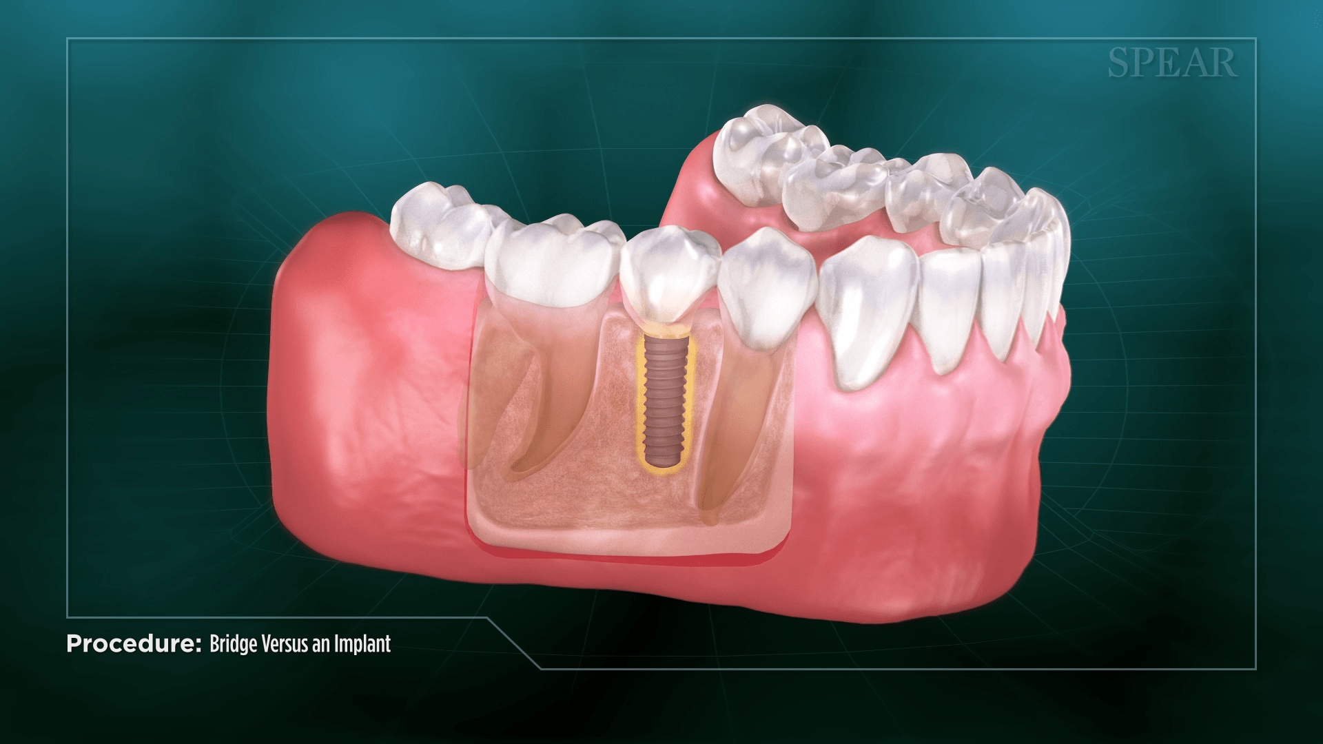 Dental Implant as an Artificial Root