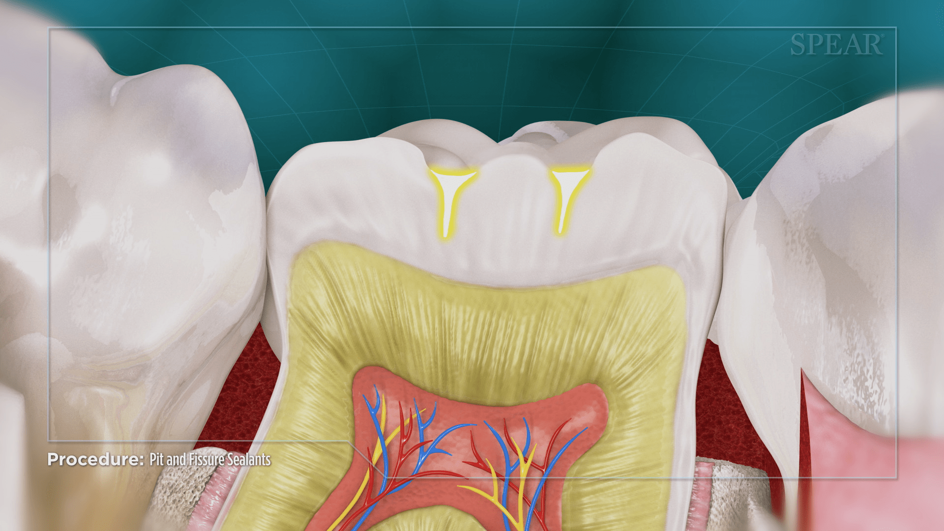 pit and fissure sealants