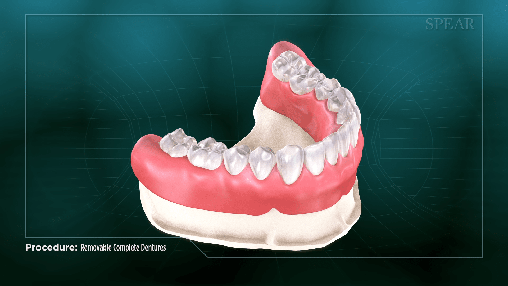 Prosthesis Design Model for Dentures