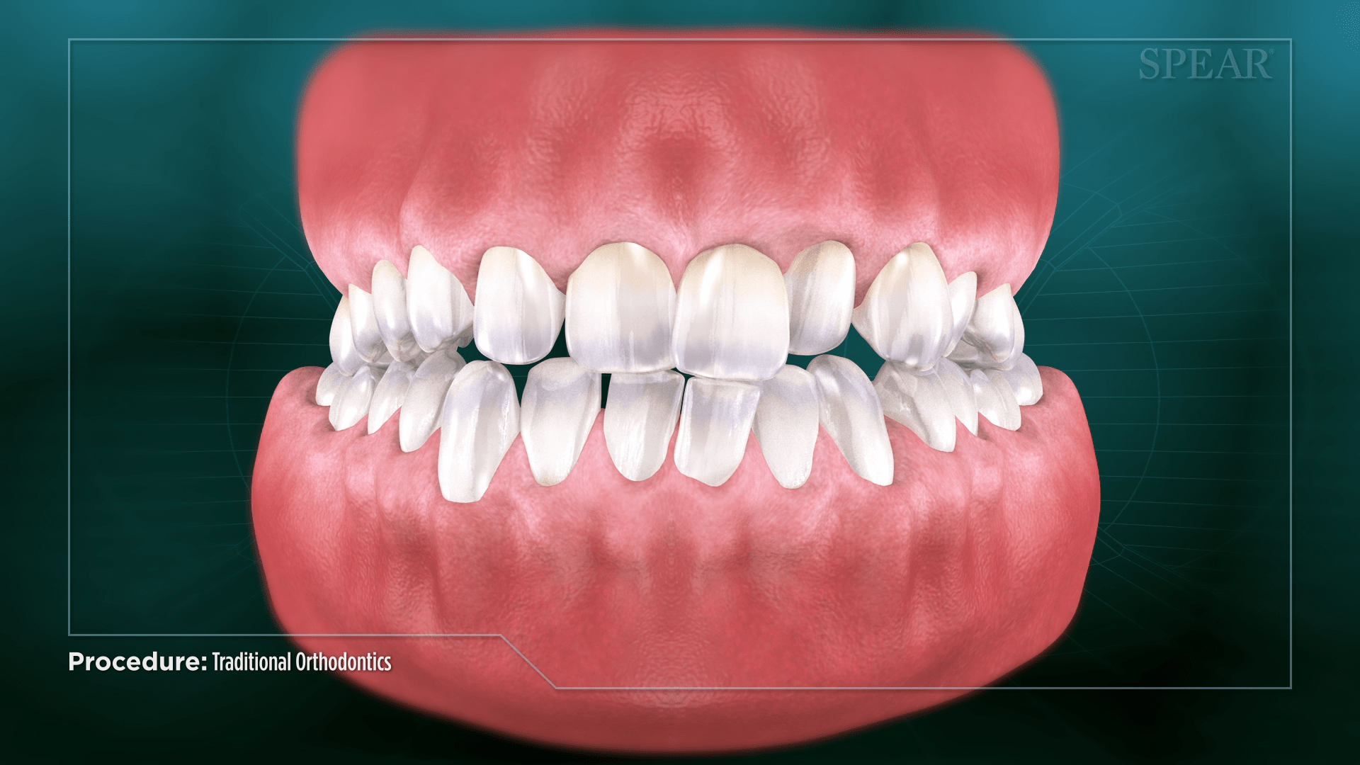traditional orthodontics