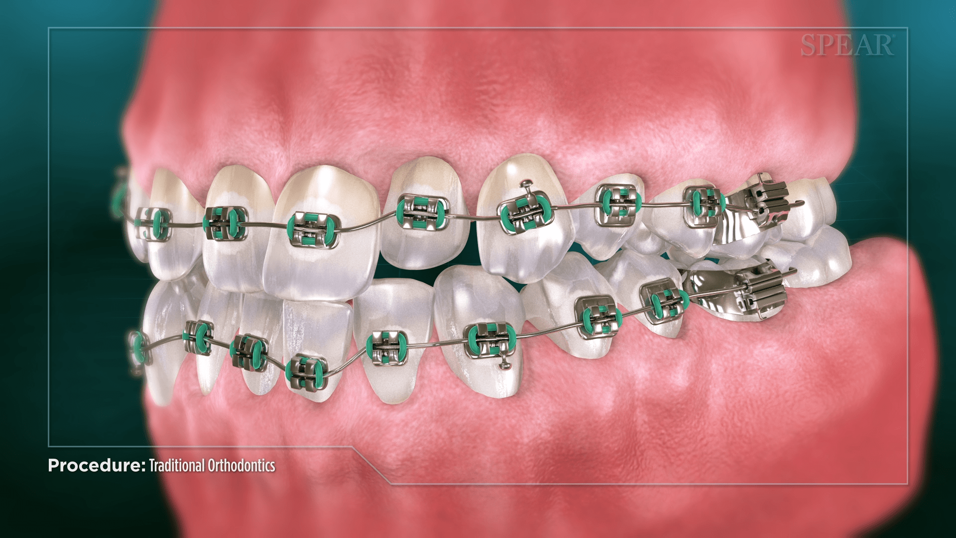 traditional orthodontics 05