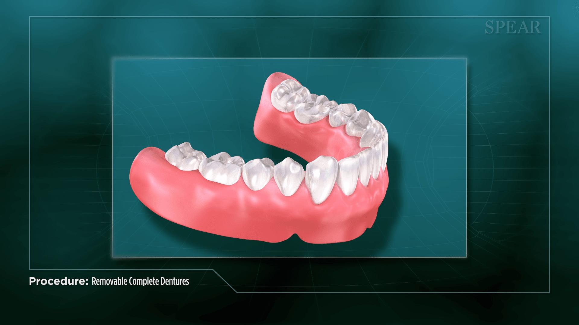 Removable Denture Fitting in Greenwood, SC